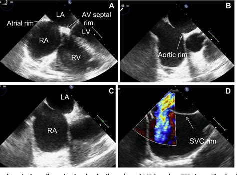 Stepwise evaluation of left to right shunts by echocardiography